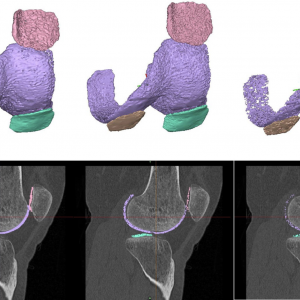 Publication: Impact of automated and manual segmentation errors on knee osteoarthritis classification using MRI-registered data on CT scans